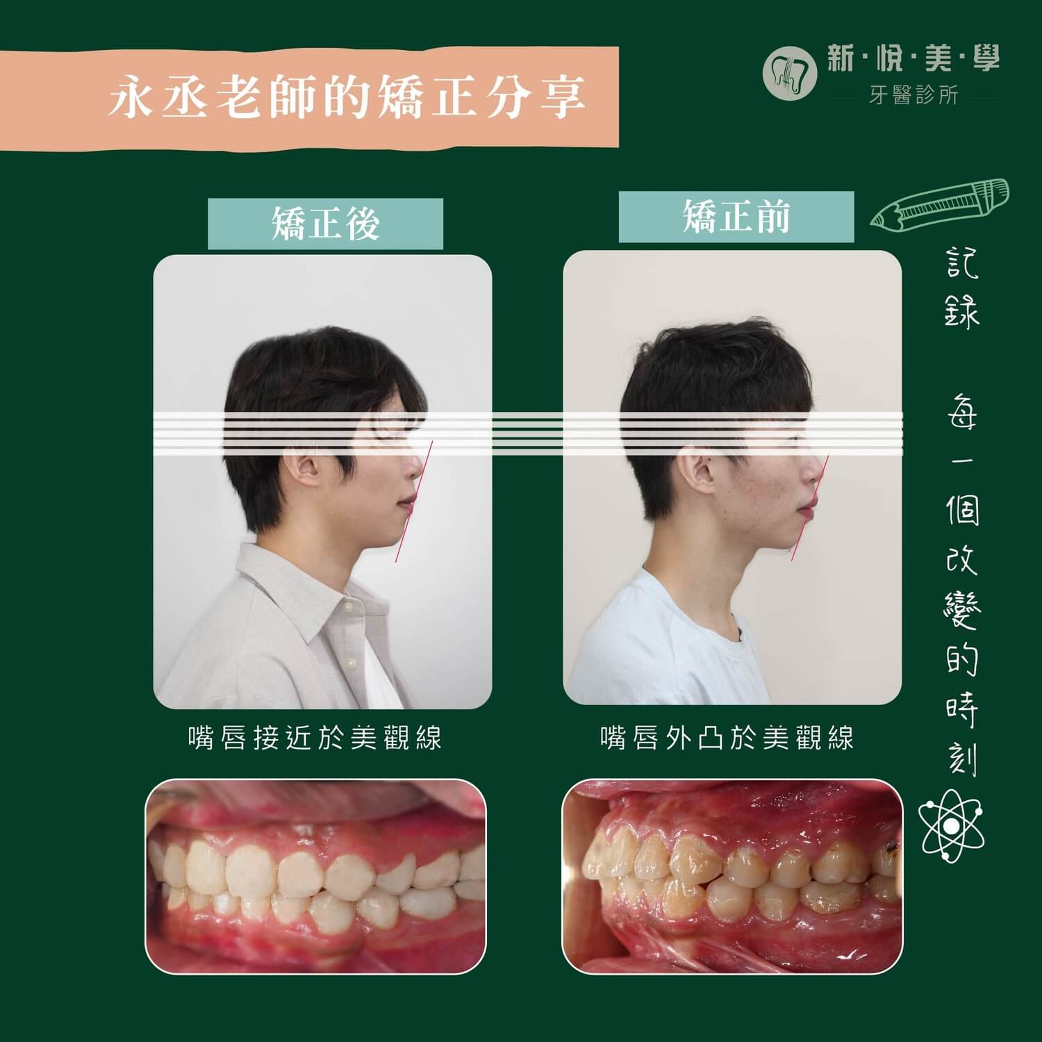 永丞老師的牙齒矯正大變身!的第2張圖片